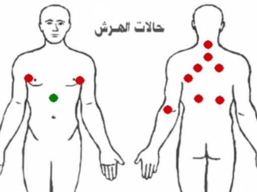 مواضع حجامة حالات الهرش