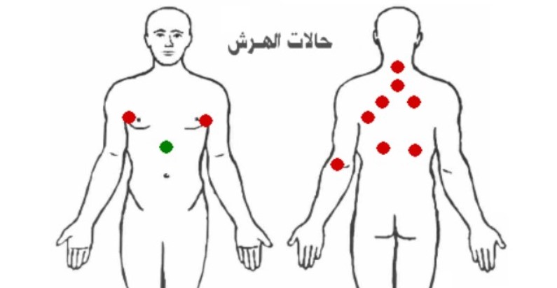 مواضع حجامة حالات الهرش
