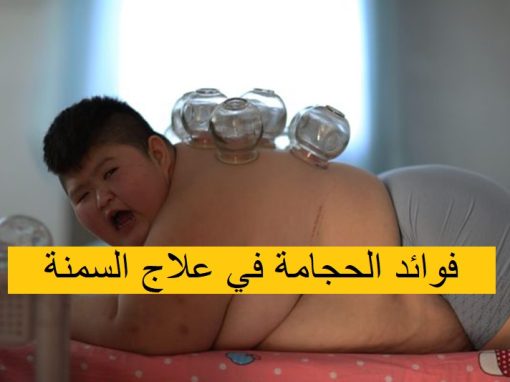 فوائد الحجامة في علاج السمنة